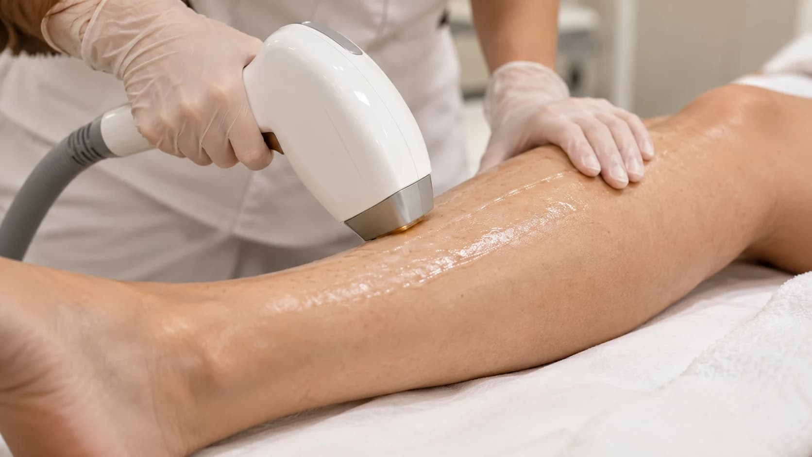Close-up van laserontharing op een onderbeen, met behandelkop en gehandschoende handen